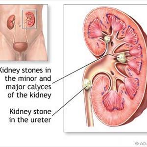 Kidney Stones Diet Kidney Stones - Too Young For Gout Disease At 30? Think Again...