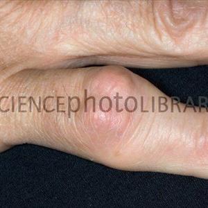 What Is Arthritic Gout 