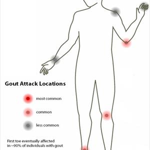  Vitamin C For Gout Treatment 