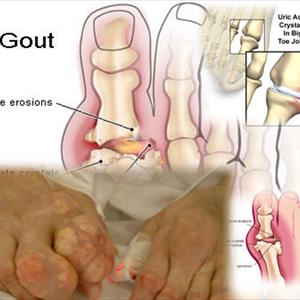 How Colchicine Effects Dividing Cells - Remedies For Gout Relief