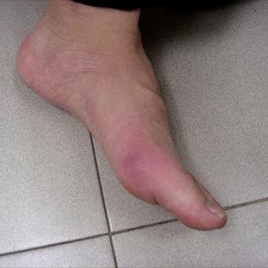 Treatment Advise For Gout 