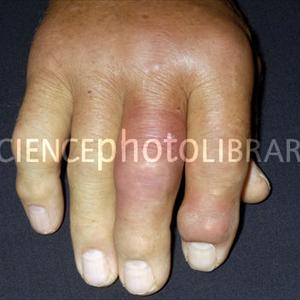 Is Allopurinol Safe - Gout Overview