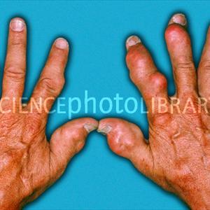 Chronic Tophaceous Gout Hyperuricemia - Natural Gout Treatment - The Results Of A Gout Diet That Had A Lot Of Success