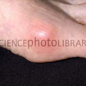 Chronic Tophaceous Gout 