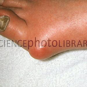  Gout Symptoms