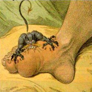  Home Remedies For Gout