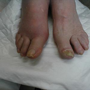 Gout Patient - Gout- Warning Signs