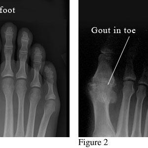 Gout Symptons - Stop Your Gout Attack In Its Tracks