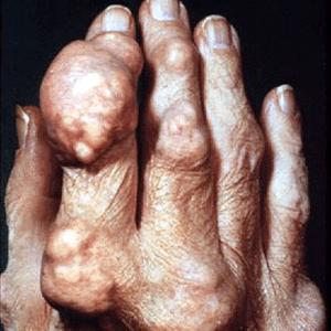 Colchine Colchicine - Interesting Facts About Arthritis