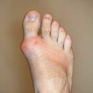  The Acidic Foods To Avoid With Gout Diets