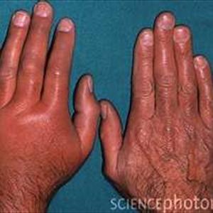 Purins Erik - Causes Of Gout