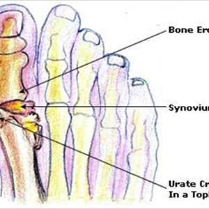 Colchicine Treatment 