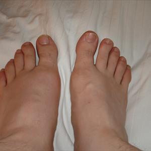  Gout Information