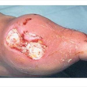  Gout Remedies