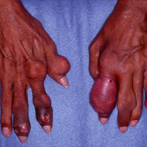 Diet Gout Treatment - Cherries - The Supercharged Fruit