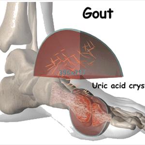  How Is Gout Treated?