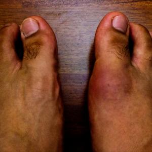 Gout Pain Reliever - How Is Gout Treated?