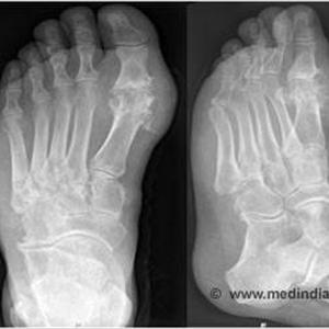  Causes Of Gout