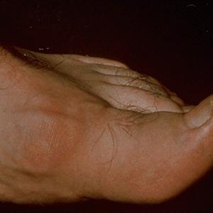  Gout Symptoms 