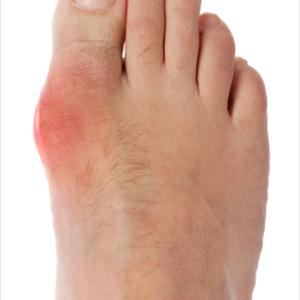 Gout In Hands Joints - The Truth About Gout