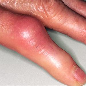 Medication For Gout Disease - Recognizing The Symptoms Of Gout