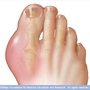 Eating For Gout - Natural Gout Treatment - How Should You Use Food To Raise Your Body Ph Levels? 