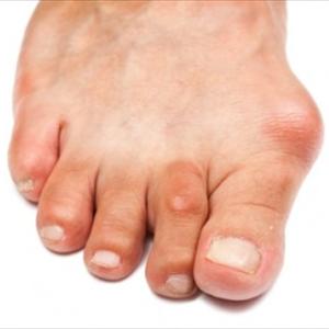 Gout Causing Foods - 4 Tips You Must Know About Low Purine Diets For Gout