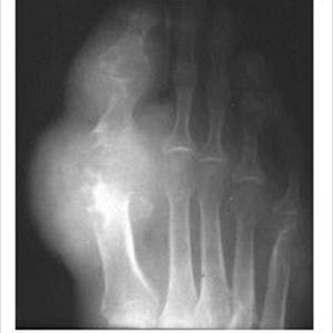 Gout Foot - Some Risk Factors In Gout Cases